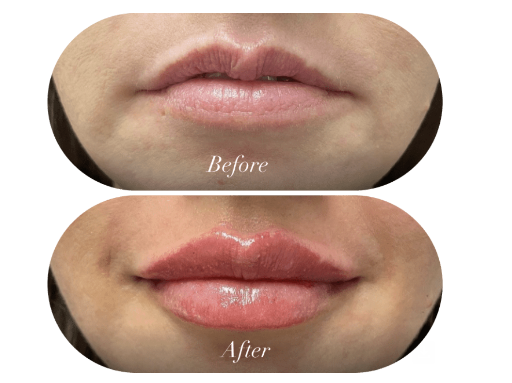 lip augmentation